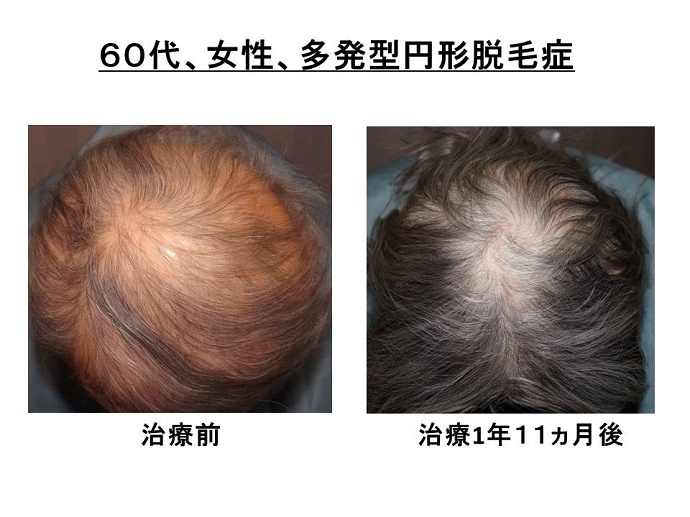 円形脱毛症　病院
